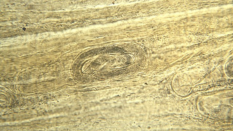 Trichinella cyst